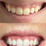 MOON ORAL BEAUTY Platinum Pro Glow Teeth Whitening Device